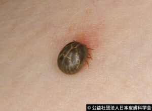 【画像あり】布団のダニ刺されで悩んでいる方へ!噛み跡の違いと対処法を解説! - 睡眠ラボ